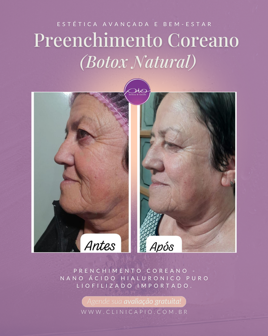 Preenchimento Coreano